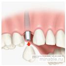 Имплантация зубов в Оренбурге